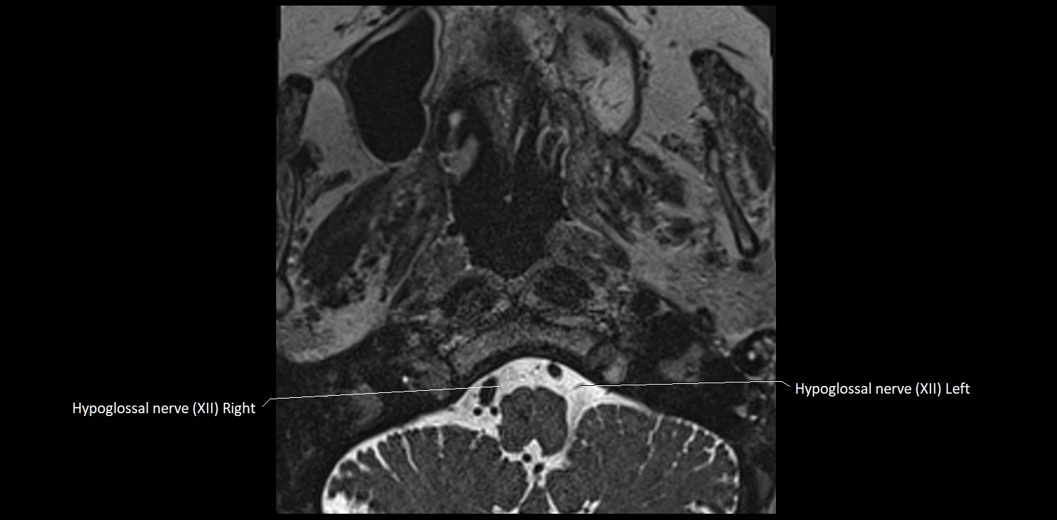 Cranial nerve anatomy axial MRI 3T image 79.webp